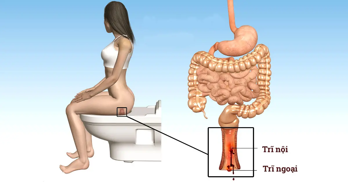 phòng khám trĩ huế phòng khám trĩ huế