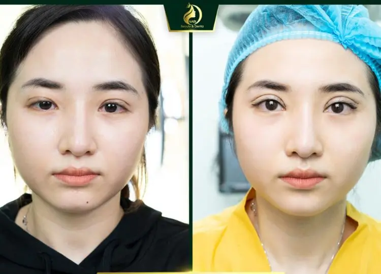 Bỏ Túi Ngay 7 Địa Điểm Cắt Mí Cần Thơ Uy Tín Nhất