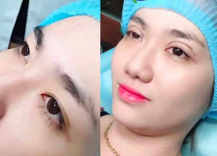 cắt mí Cần Thơ nhấn mí uy tín