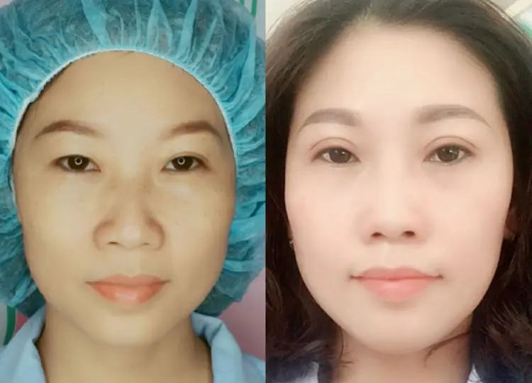 cắt mí Cần Thơ cắt mí Cần Thơ