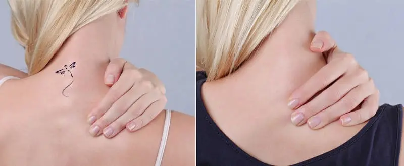 Khám Phá Ngay Top 7 Địa Chỉ Xóa Xăm Đà Nẵng Chất Lượng