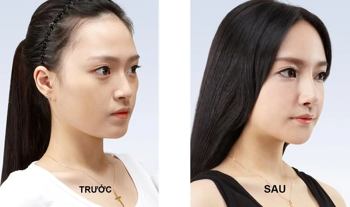 nâng mũi Đà Nẵng Thẩm Mỹ Trần Vũ