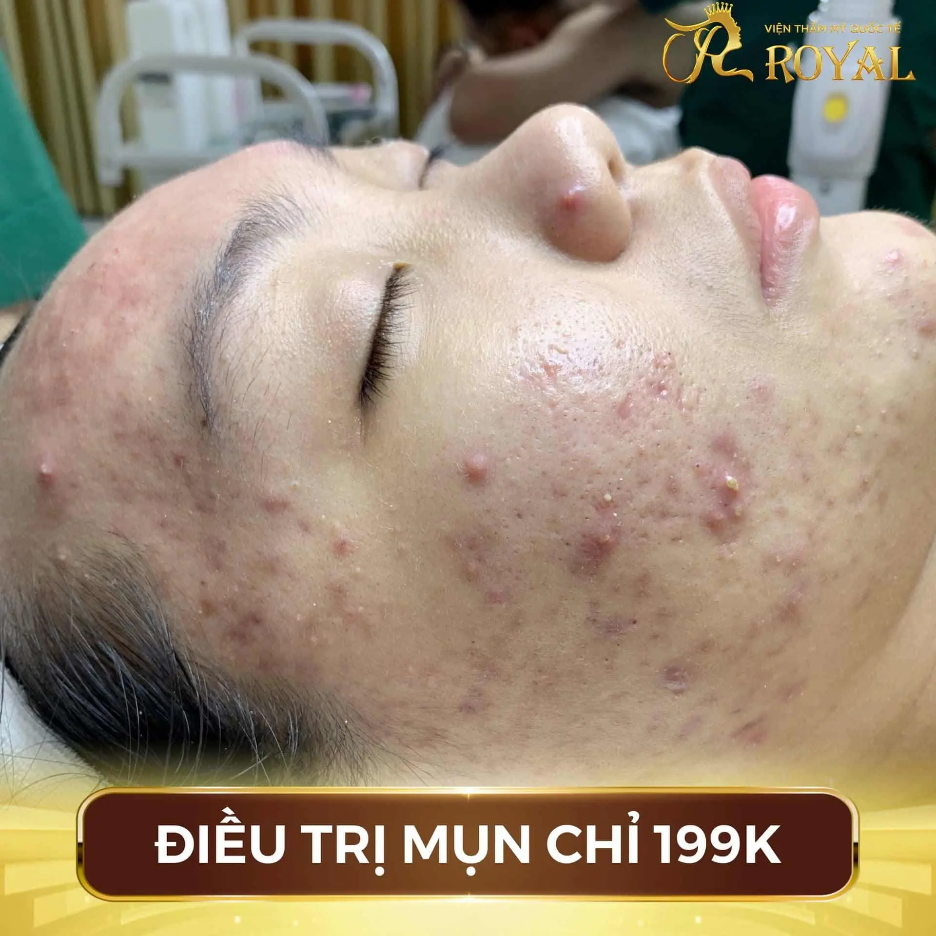 spa trị mụn Hải Phòng trị mụn lượng