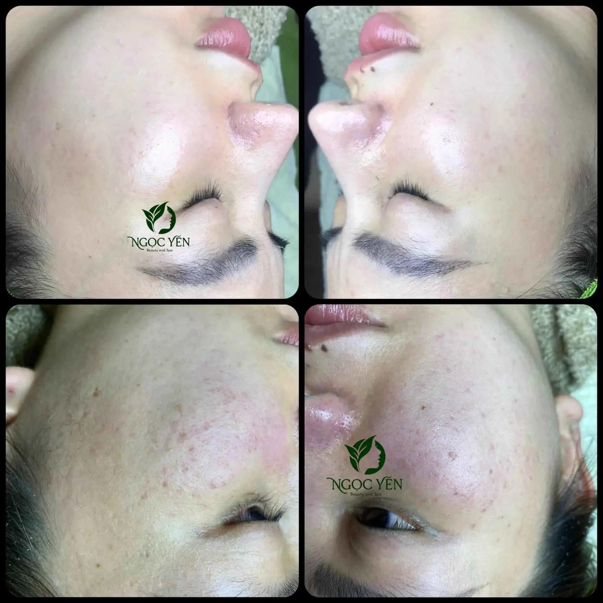 spa trị mụn Hải Phòng trị phòng uy tín hàng đầu