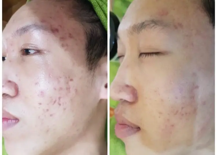 spa trị mụn Hải Phòng mụn rỗ khó chữa