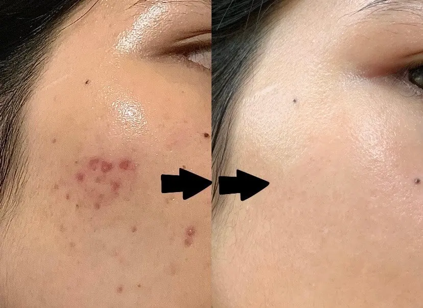 spa trị mụn Hải Phòng spa giá tốt Hải Phòng