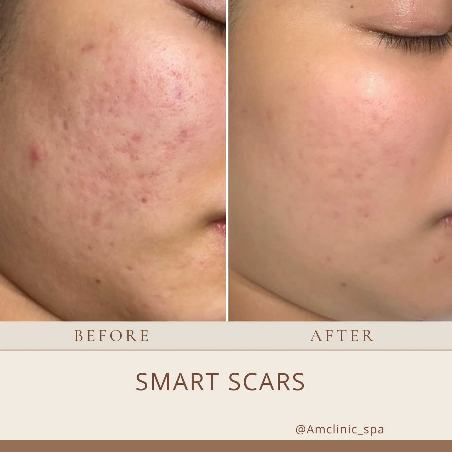 spa trị mụn Hải Phòng ẩm clinic mụn toàn thân