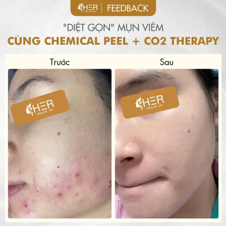 Khám Phá Top 10 Spa Trị Mụn Hải Phòng Uy Tín, Hiệu Quả