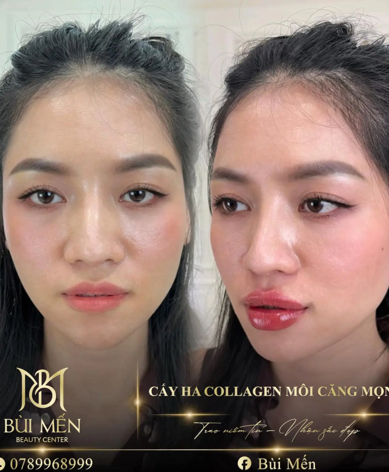 tiêm filler nha trang tiêm filler nha trang