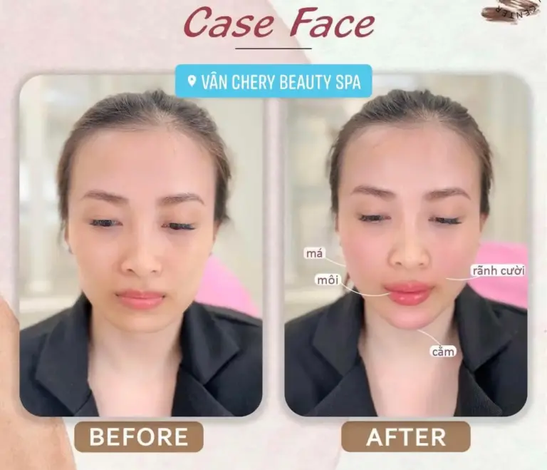 Điểm Danh 11 Địa Chỉ Tiêm Filler Nha Trang Uy Tín