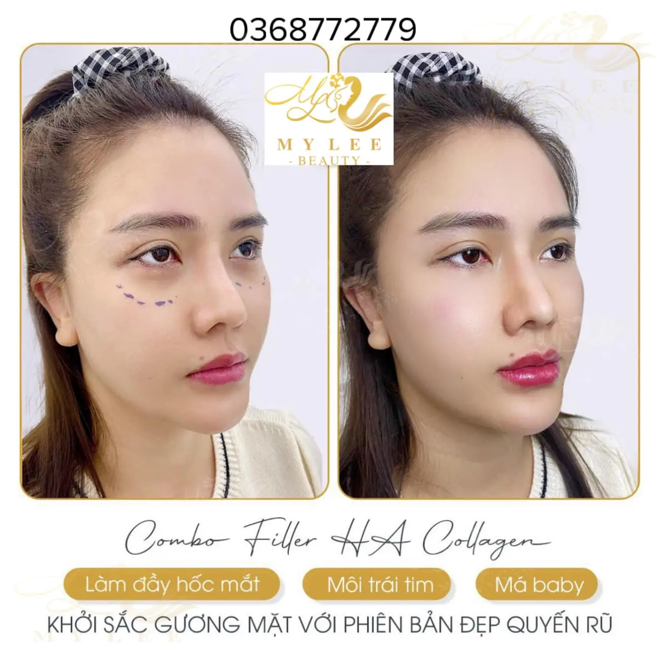 Tiêm Filler Nha Trang Spa My Lee Beauty Clinic