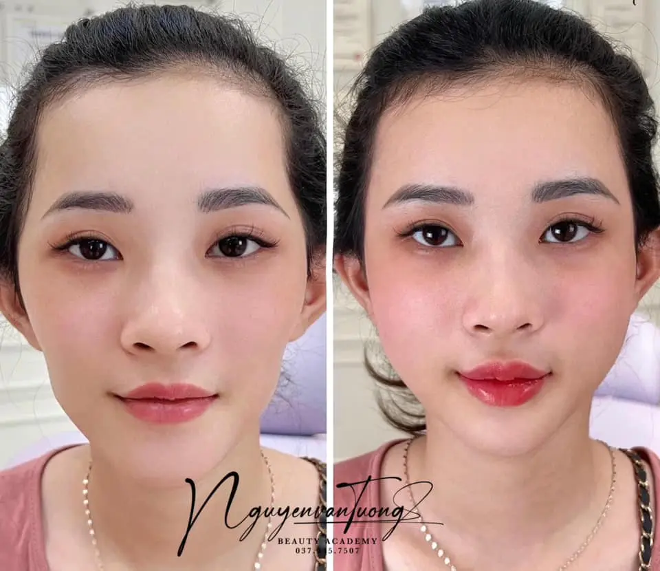 tiêm filler Nha Trang tiêm filler Nha Trang