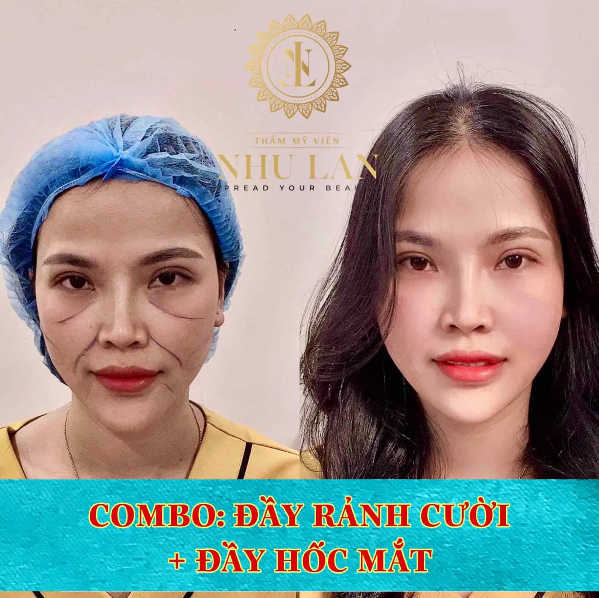 tiêm filler Nha Trang Viện Thẩm Mỹ Như Lan