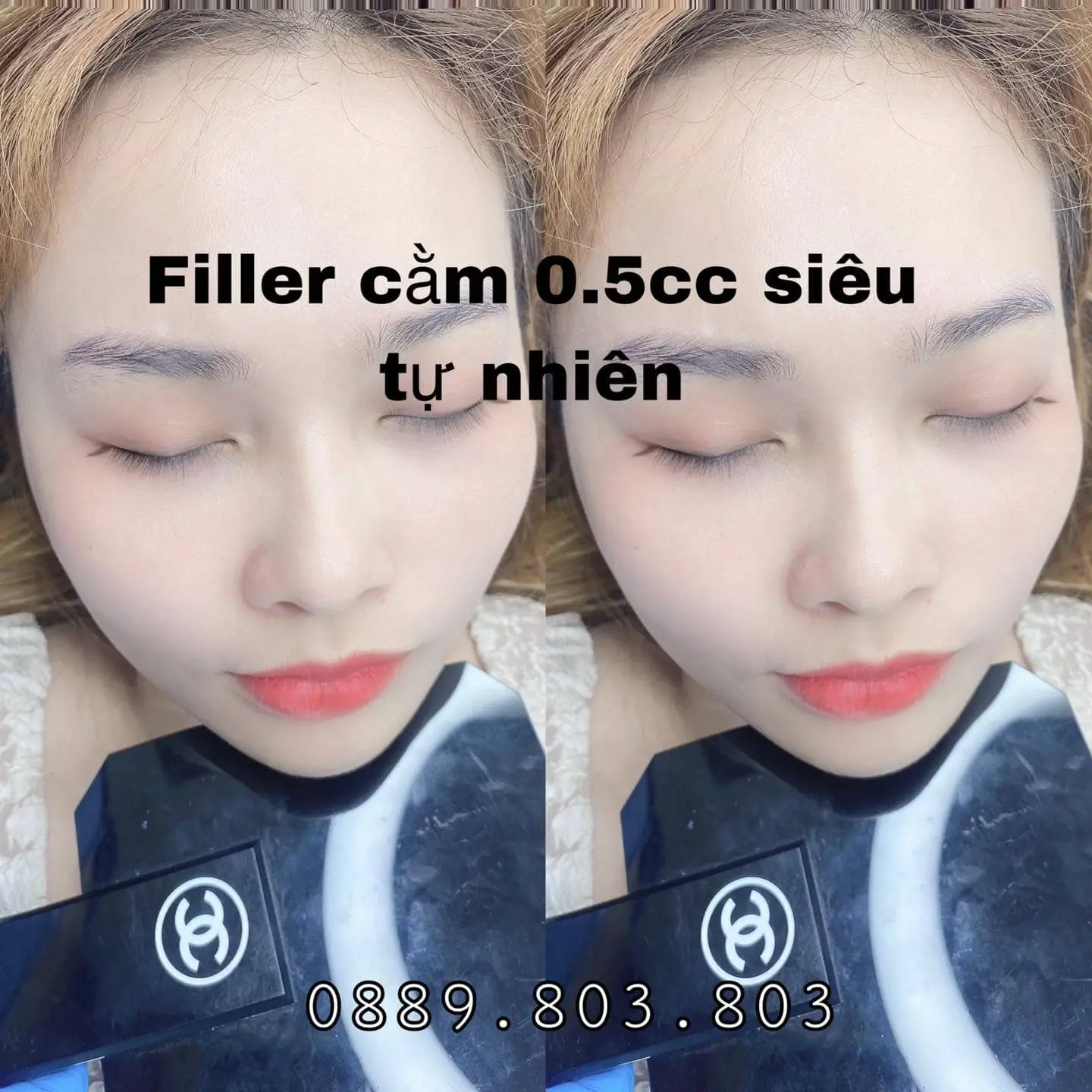 tiêm filler Nha Trang Viện Thẩm Mỹ Anna Huỳnh