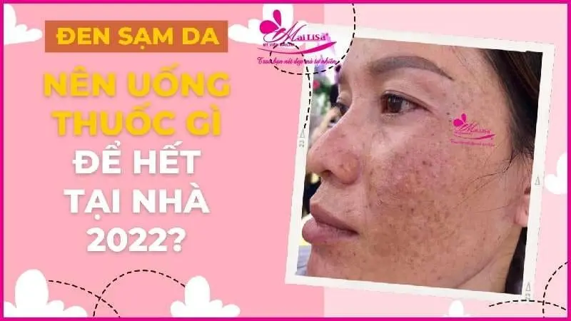 trị nám tàn nhang đà nãng