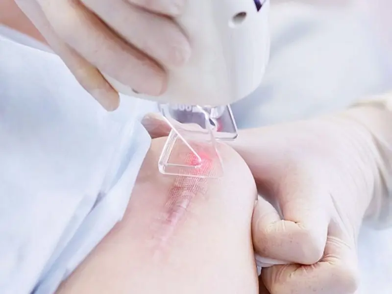 trị sẹo lồi đà nẵng