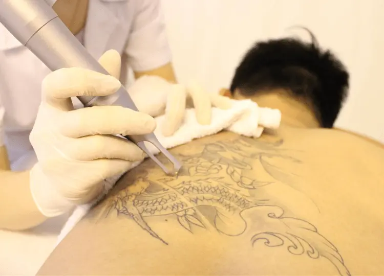 Xóa hình xăm bao nhiêu tiền giá xóa hình xăm