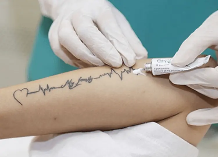 Xóa hình xăm bao nhiêu tiền giá xóa hình xăm