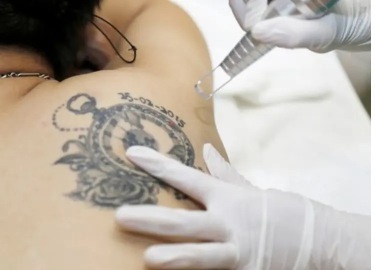 Xóa hình xăm bao nhiêu tiền xóa hình xăm