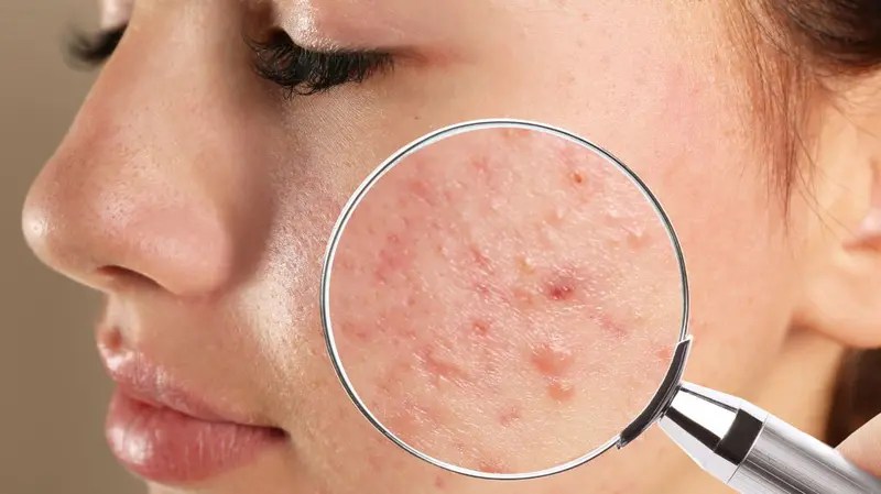 toi-thang-co-nen-di-spa-nan-mun-khong-1 tới tháng có nên đi spa nặn mụn không