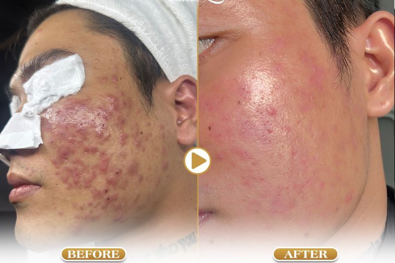 spa lấy nhân mụn uy tín ở đà nẵng