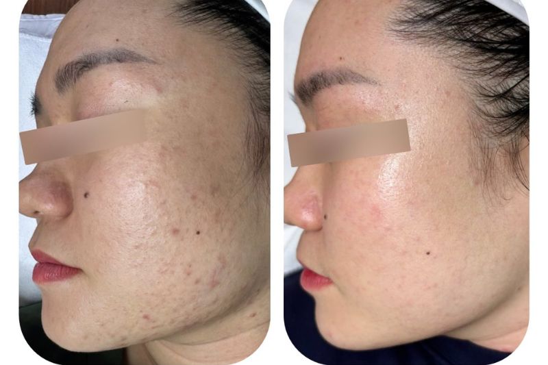 spa lấy nhân mụn uy tín ở đà nẵng