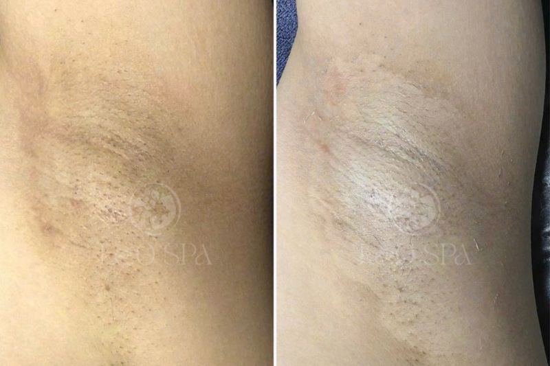 spa trị thâm nách đà nẵng