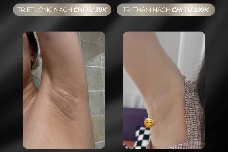spa trị thâm nách đà nẵng