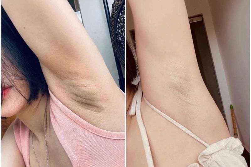 spa trị thâm nách đà nẵng